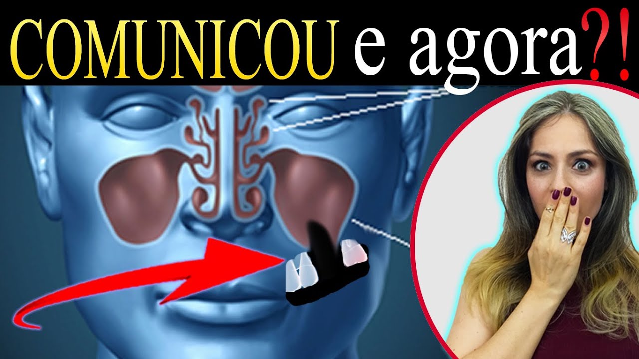 (COMO RESOLVER) a Comunicação Buco-sinusal depois de extraor o dente (SISO), volta ao normal