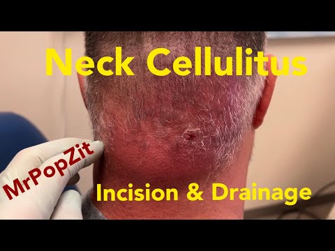 Serious Neck Cellulitus. Large fluid pocket drained. Area has ripened and is ready for drainage.