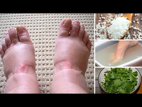 Pinakamahusay na pamahid para sa paggamot ng mga halamang-singaw sa pagitan ng toes Ito break ang balat sa kamay sa ilalim ng kuko kung ano ang gagawin kung paano tratuhin