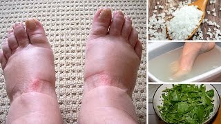 Home remedies for swollen feet