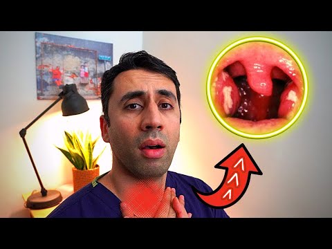 What Causes a Sore Throat HOME Remedies and Cures for Fast TREATMENT| Doctor Explains