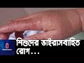 শিশু হাসপাতালে প্রতিদিন চিকিৎসা নিচ্