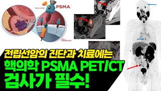 전립선암 진단 PSMA PET-CT 검사 방법