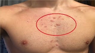 how to get rid of chest acne scars overnight