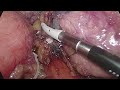 『胰臟』腹腔鏡胰尾切除手術 Laparoscopic distal pancreatectomy(Warshaw procedure)