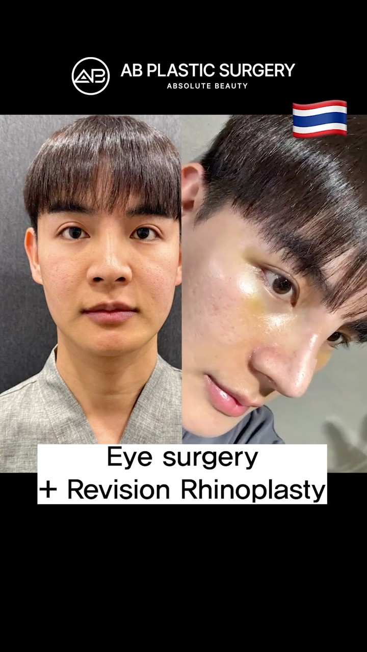 Revision Rhinoplasty + Eye surgery – Shocking Change