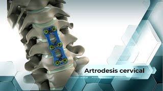 Artrodesis cervical