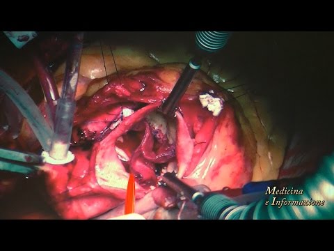 Aneurism della carotide del collo Trattamento sintomi Osteocondrosi Clinica Neurologica