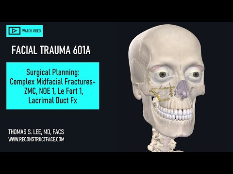 ZMC, NOE, Le Fort 1 Fx CT Review, Surgical Planning OR Q&A" [601A] Didactic