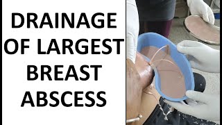 Largest Breast Abscess Drainage
