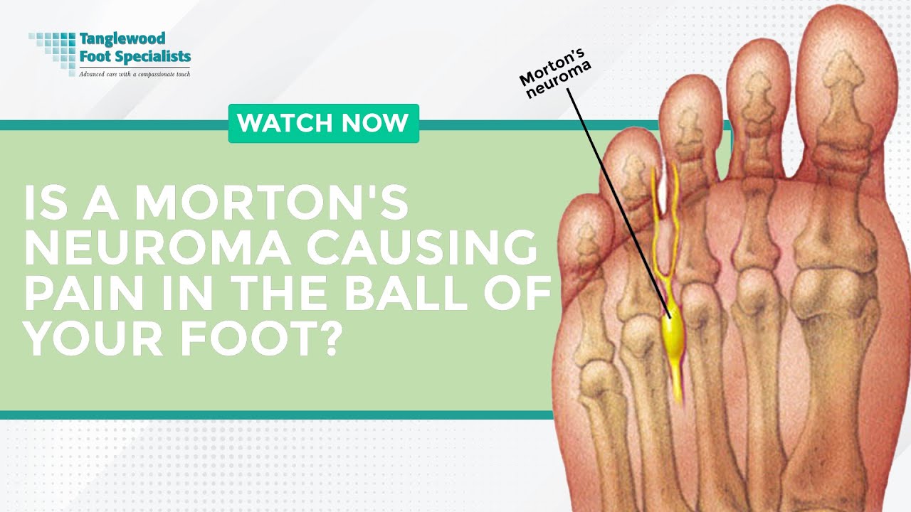 Is a Morton's Neuroma Causing Pain in the Ball of Your Foot?