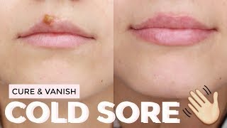 HOW TO : Cure a cold sore FAST | Healed &amp; Scab Free