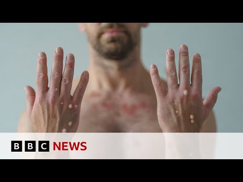 Video | First case of more spreadable mpox detected in UK | BBC News