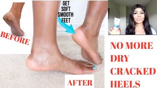 HOW TO GET RID OF DRY CRACKED HEELS VERY FAST | MAINTAIN YOUR DRY FEETS
