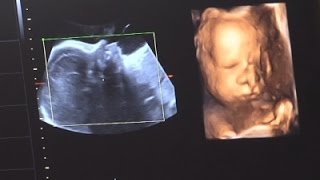 Three Generations of Family Tied to Single Womb