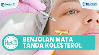 Waspadai Benjolan di Sekitar Mata Bisa Jadi Tanda Kolesterol Tinggi, Kenali Gejala sejak Dini