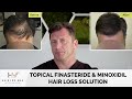 Topical Finasteride & Minoxidil Hair Loss Solution - How To Use