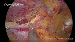 Totally Extraperitoneal (TEP) Laparoscopic Surgery for Bilateral Inguinal Hernia repair