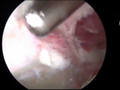 Reparación del labrum con endoscopio de cadera