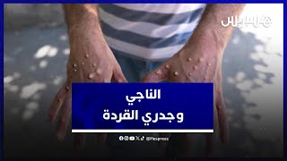مصطفى الناجي: "جدري القردة" ظهر أول مرة سنة 1958 .. وهو سريع الانتشار ويصيب جميع الأعمار thumbnail