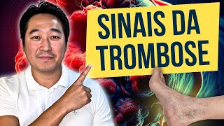 5 SINAIS INICIAIS DE UMA TROMBOSE.