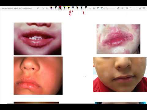 Eczemi su una faccia a bambini Cura di psoriasi regione di Donetsk