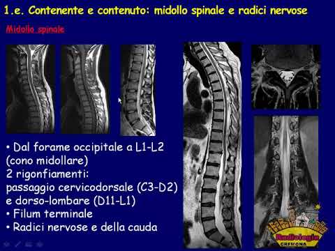 Ernia sulla caviglia Tutti i sintomi della malattia degenerativa del disco della colonna lombare-sacrale