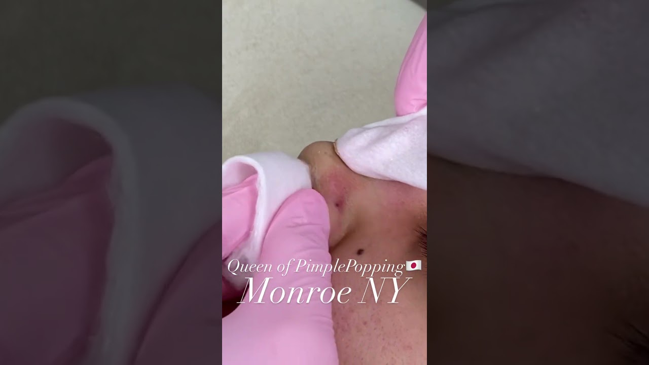 #毛穴エクストラクション しっかり根本から角栓除去