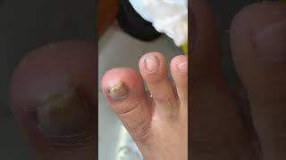 Ep_8190 Foot nail skin removal 👣 Take care of it like my brother told me..you won't have it again...