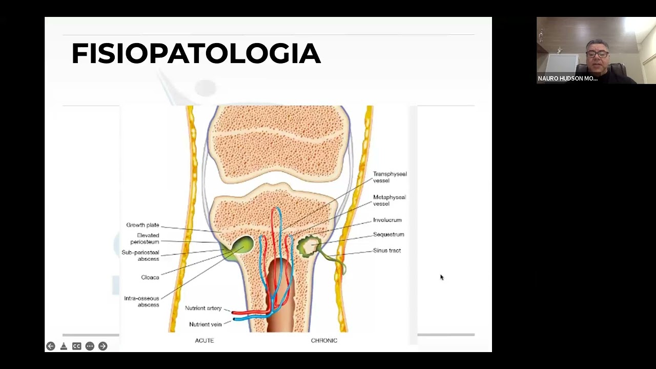 AULA OSTEOMIELITE OUT 23