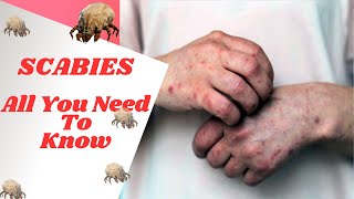 How To Identify & Treat Scabies: Causes, Symptoms, and Prevention