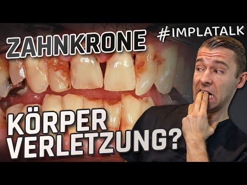 Was dir dein Zahnarzt NICHT über Kronen sagt 😳💥