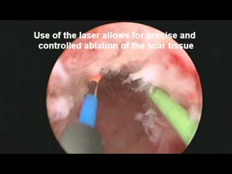 Urethral Stricture Treatment with the Holmium Laser 