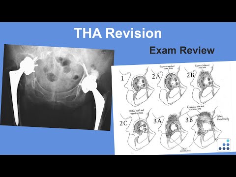 THA Revision Exam Review - Wayne Paprosky, MD