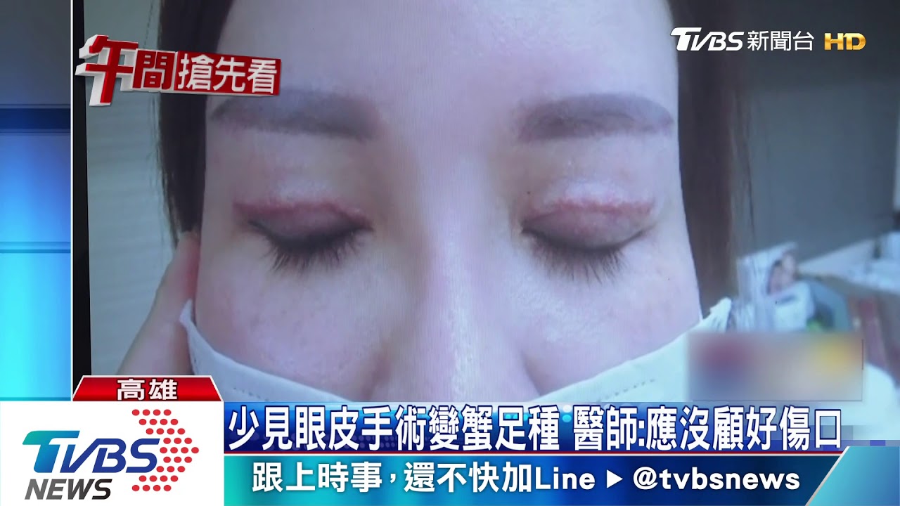 雙眼皮變紅蜈蚣 整型手術引發蟹足腫