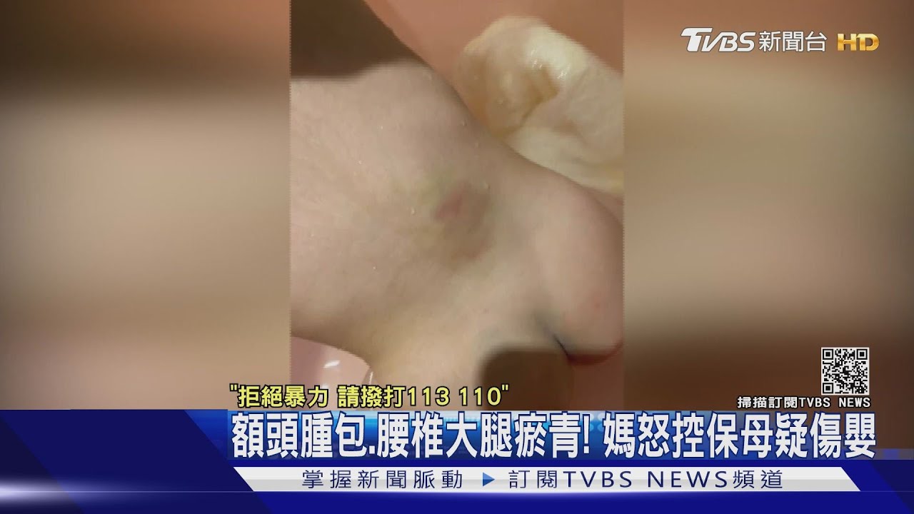 男嬰腰椎出現「鴨蛋大瘀青」 媽怒控疑遭合法保母傷