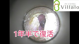 耳掃除動画vol.71「1年半で復活」