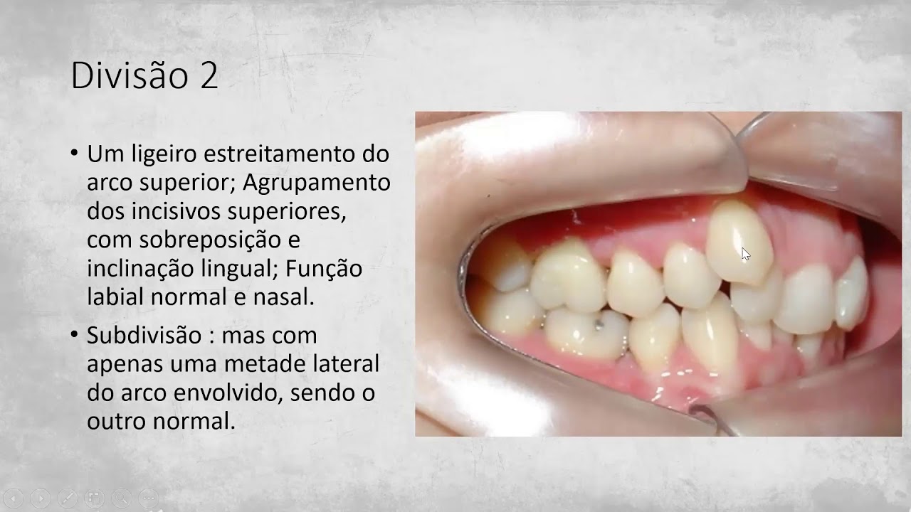 Sistema de classificação de Angle e as Seis chaves de Oclusão de Andrews.