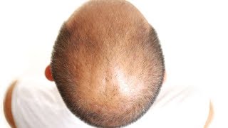 The Hair Loss DHT Myth: Baldness Cure Debunked