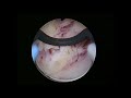 Bipolar Transüretral Prostat Enükleasyonu TUEP / Altuğ Tuncel