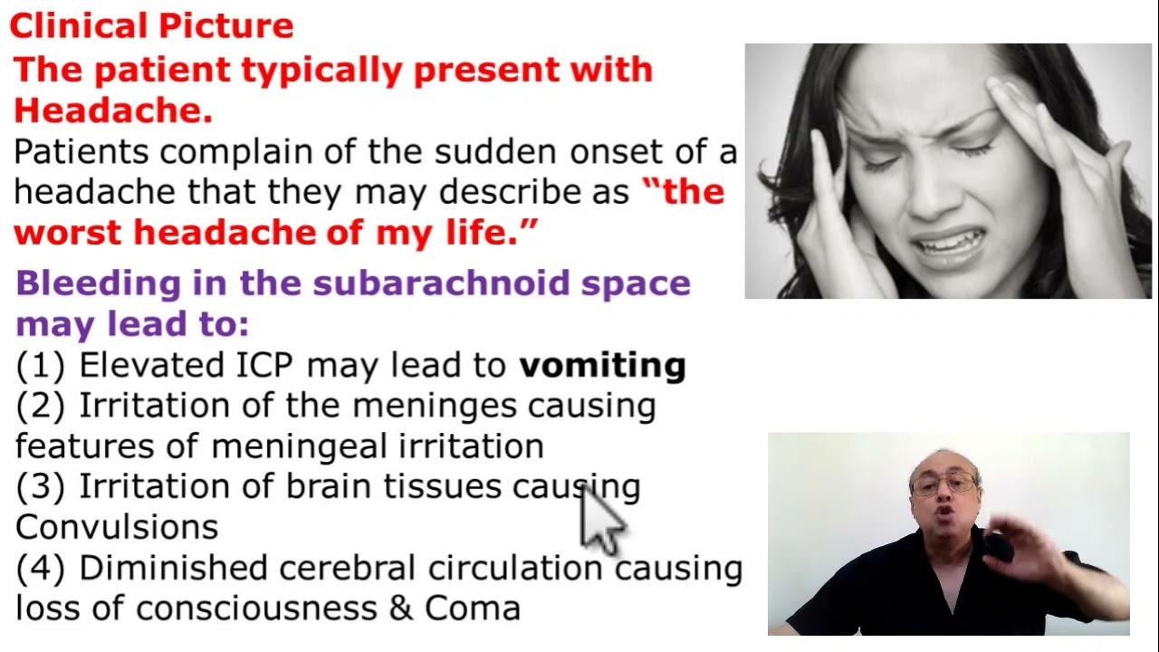 Subarachnoid Hemorrhage