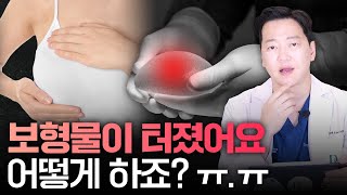 이 방법으로 만족스러운 재수술 결과를 만들어 드렸습니다.