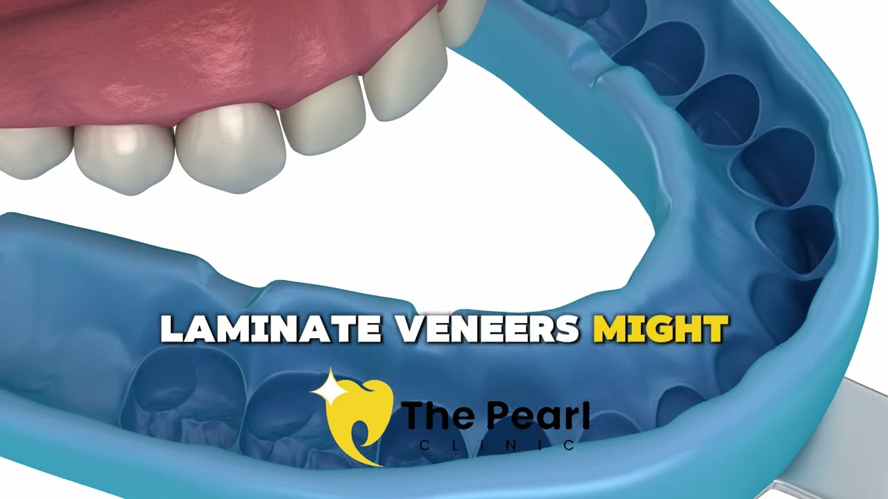 Laminate Veneer – BL2 -Natural Style - Video