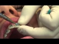 Putting Braces On