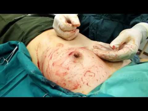 Bihisan para sa mga maliliit suso kasal Pagkatapos pagpapasuso kapag ito ay posible upang madagdagan ang dibdib
