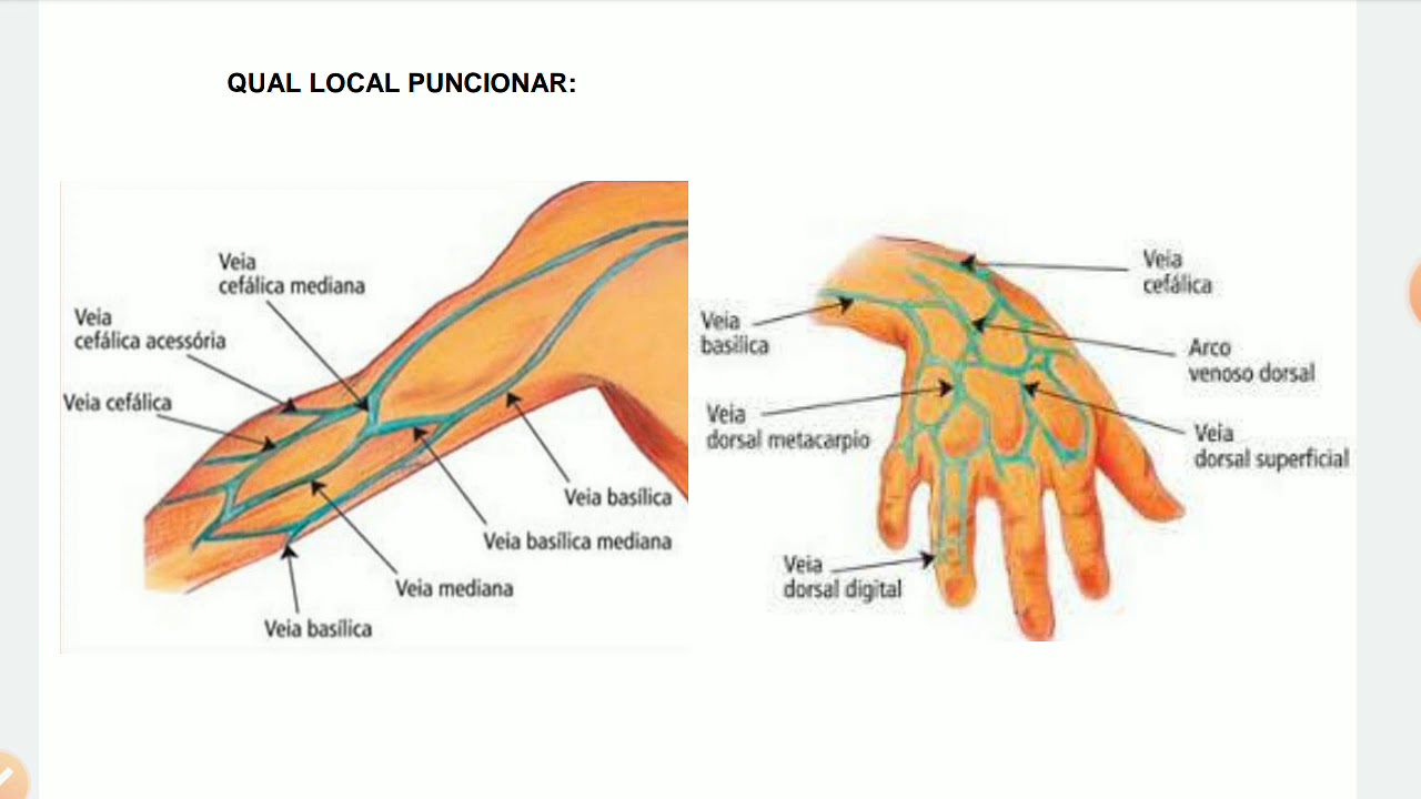 Qual a melhor veia para puncionar ?