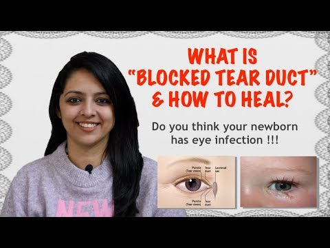 Infant watery or sticky eyes- blocked tear duct