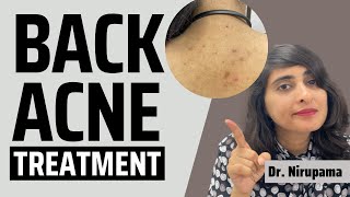 Back Acne| Pimples on back| Back acne treatment| Back acne spots| How to get rid of back acne?(2022)