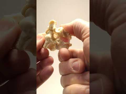 Central Cervical Disc Herniation Model