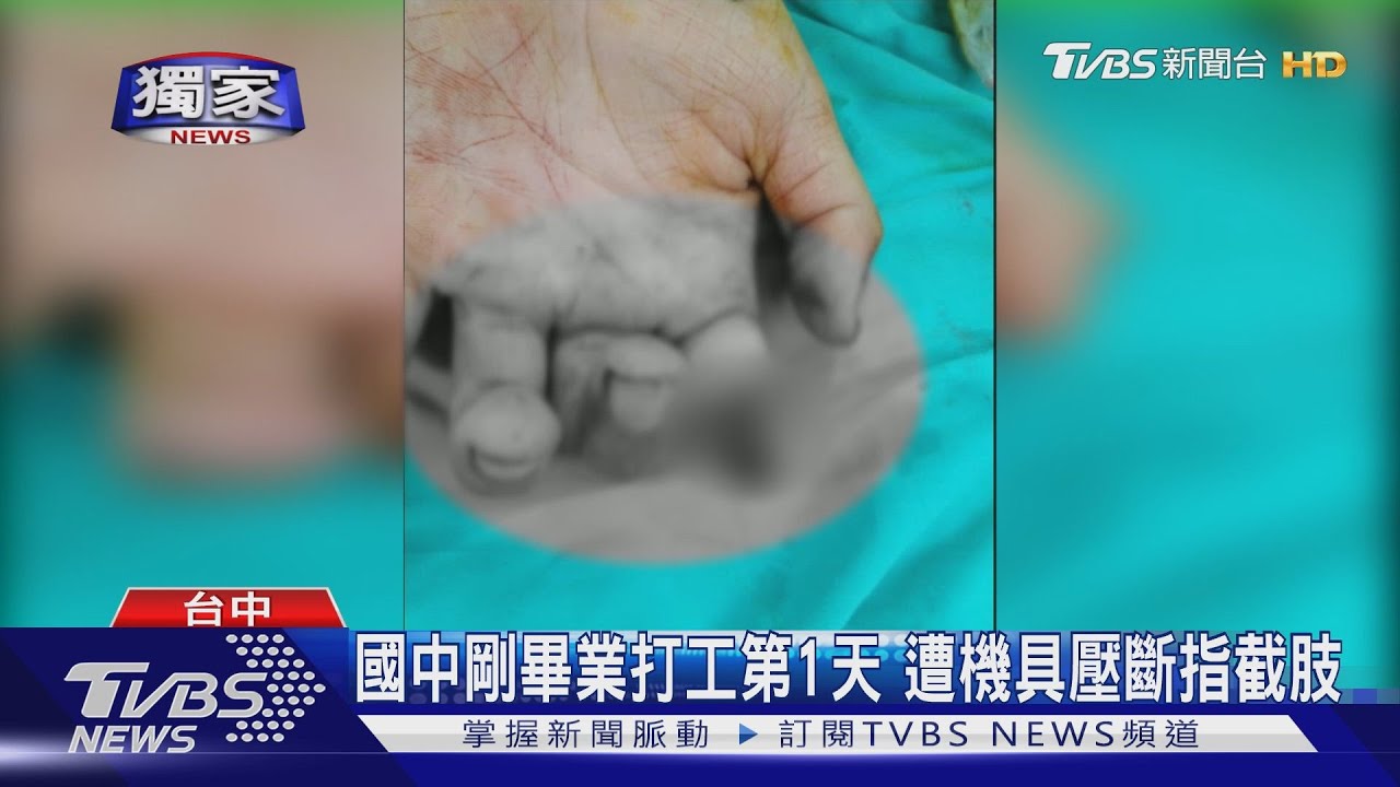 國中剛畢業打工第1天 遭機具壓斷指截肢